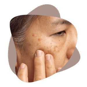 لک ناشی از افزایش سن 