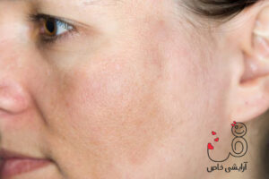 یک ناشی از آفتاب و آفتاب سوختگی